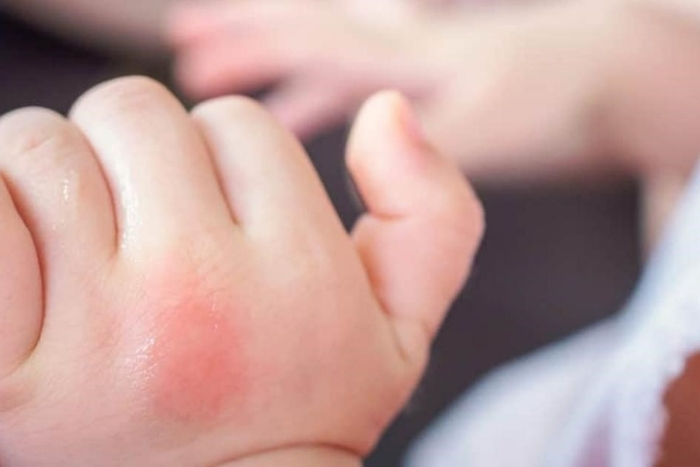 Mosquitoes and tropical diseases
